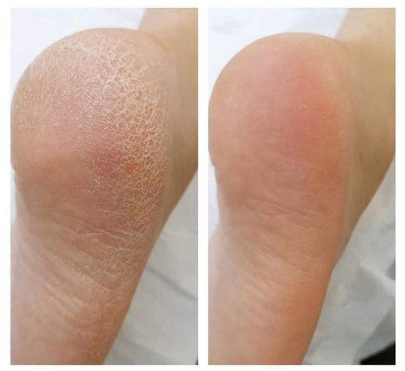 Instant Foot Peel Essential Kit